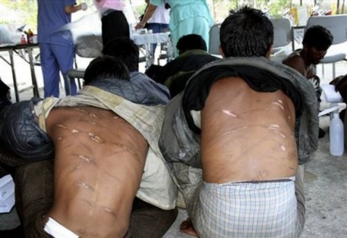 Rohingya migrants show their wounds while waiting for treatment at the provincial hospital in Ranong province, southern Thailand, Tuesday, Jan. 27, 2009. A new boatload of the 78 ethnic Rohingya migrants was detained in Thailand, several with lacerations, burns and other wounds they said were inflicted by Myanmar soldiers, Thai authorities said. (AP Photo)